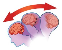 Illustration of head with brain moving back and forth, indicated by an arrow.